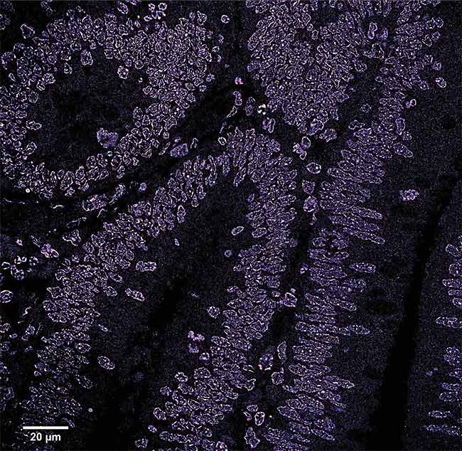 A stochastic optical reconstruction microscopy (STORM) image of a region of a colon polyp. The image shows the disruption of the chromatin structure in the early stages of cancer. Courtesy of the University of Pittsburgh.