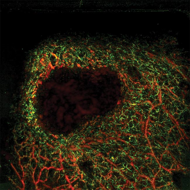 Skin tissue with a melanoma (dark area) and the surrounding structure of very fine blood vessels. Multispectral photoacoustic imaging technology is a noninvasive technique that offers great penetration depth and high resolution. The short-pulse laser sources that drive these systems contribute significantly improved image data that can provide more detailed diagnoses of tissue under examination. See Reference 1. Courtesy of Mathias Schwarz.