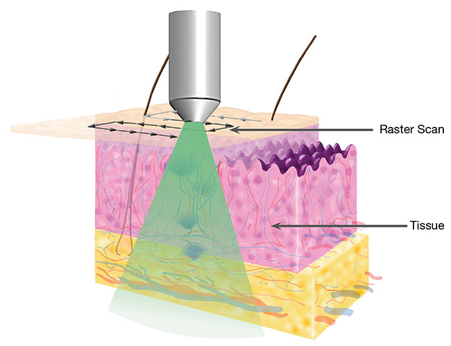 Raster-scanning optoacoustic mesoscopy (RSOM) employs a photoacoustic imaging technique that scans a multispectral laser system across tissue to maximize the examination area 