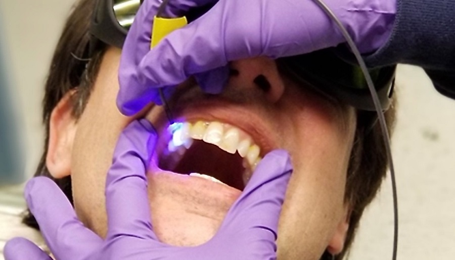 A new UW dental tool prototype uses a low-power light system to monitor reactions with a fluorescent dye solution to identify where tooth enamel is most at risk from the acidity of plaque. Courtesy of the University of Washington and IEEE Xplore/Creative Commons. 