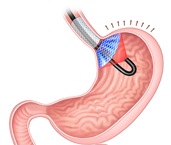  An implant (blue and gray) creates a feeling of fullness by pressing on the stomach and, when activated by a laser (black), kills cells that produce the hunger hormone. The research advances work from 2019 that led to the development of a device to treat obesity in a nonsurgical way, though that yielded side effects including acid reflux. Courtesy of CS Applied Materials & Interfaces.