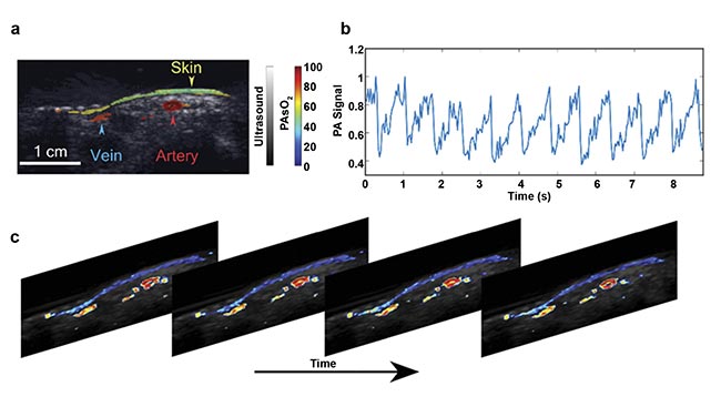 Figure 4. In vivo imaging of the oxygen saturation of blood vessels in a human wrist, acquired using dual-wavelength (750 and 850 nm) LED-based photoacoustic imaging. An image of fluence-compensated photoacoustic (PA)-based oxygen saturation (sO2) of a human wrist overlaid on an ultrasound image (a). The normalized photoacoustic signal from an artery showing pulsation (b). PA sO2 frames showing the pulsating artery (c). Adapted with permission from Reference 7.