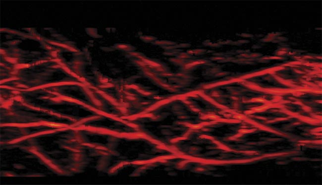 Photoacoustic imaging captures the microvasculature. Courtesy of CYBERDYNE Inc.