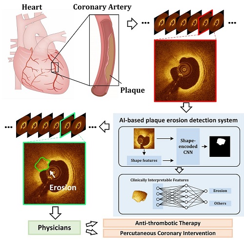 AI, OCT Operate in Tandem to Detect Plaque Erosion in the Heart