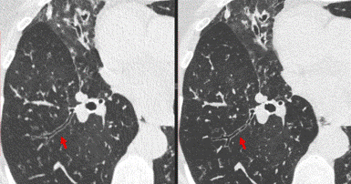 Conventional chest CT image (left) of the human airways compared to the new and improved PCD-CT system. The image produced with the PCD-CT system showed better delineation of the bronchial walls. Preliminary studies showed that the PCD-CT system allowed radiologists to see smaller airways than with standard CT systems. Courtesy of Cynthia McCollough, Mayo Clinic.
