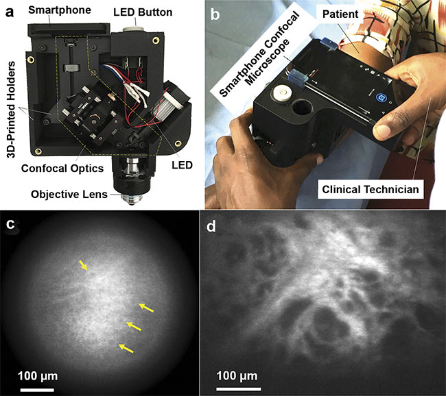 Figure 2. Photos of the first portable, smartphone-based RCM device (top row) and the confocal images obtained using it (bottom row). The RCM module is fabricated with 3D-printed holders and mounted on a smartphone (a). The instrument was tested in Uganda, where clinical technicians used it to image skin lesions (b). In vivo confocal images visualized epidermal cells (c), and ex vivo confocal images visualized irregularly shaped and sized dark spaces, which may be associated with capillaries that are indicative of Kaposi’s sarcoma (d). Adapted with permission from Reference 4.