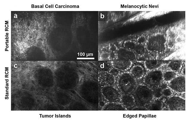 Figure 3. Confocal images of common skin lesions obtained using a portable RCM device that uses near-infrared light (top row) and a standard RCM device (bottom row). The portable device was able to similarly visualize characteristic cellular morphologic features of lesions as compared to the standard RCM device. Tumor islands in basal cell carcinoma (a, c) and edged papillae in melanocytic nevi (b, d). Adapted with permission from Reference 5.