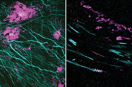 In these two images, the magenta signal is the amyloid-beta nanostructure, revealed by post-expansion staining. The left image shows the thread-like patterns of amyloid-beta nanoclusters, and the right image shows the helical structure of amyloid-beta, which was not revealed using previous techniques. Courtesy of Zhuyu Peng and Jinyoung Kang, MIT.