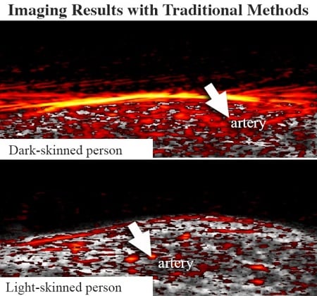 A comparison of the PA images from two different study participants, where imaging through darker skin shows more signal clutter, obscuring arteries, than imaging through light skin. Courtesy of Johns Hopkins University/University of São Paulo, Brazil.
