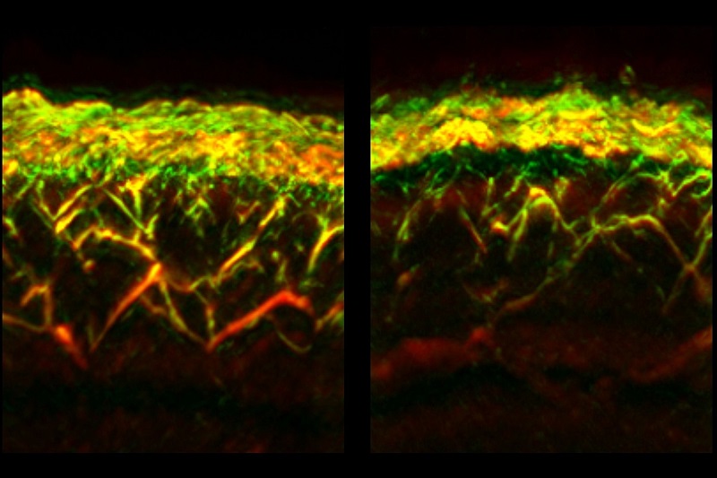 RSOM images of the skin of a healthy volunteer (left) and a patient with diabetes. Courtesy of Nikoletta Katsouli/TUM.