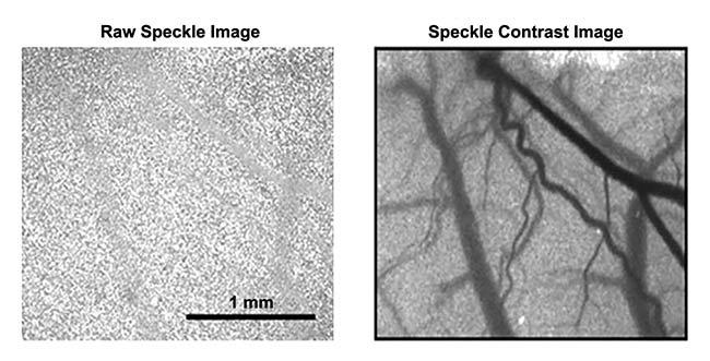 Figure 1. An example of a raw speckle image (left) and speckle contrast image (right). Adapted with permission from Reference 1.