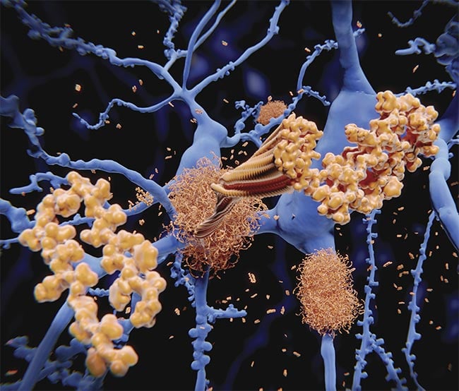 Some of the mystery surrounding the progression of amyloid structure could be answered with Raman spectroscopy. Courtesy of iStock.com/selvanegra.