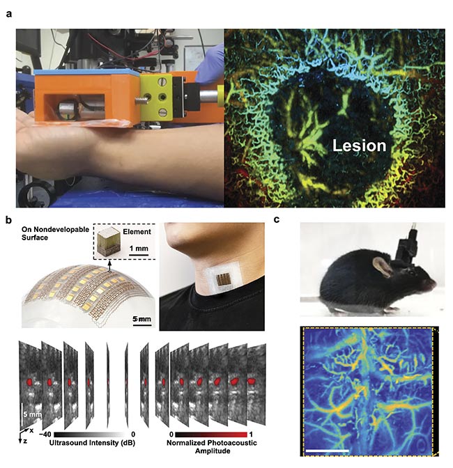 Figure 3. A hand-held PAM system (a, left) in operation for mapping a skin lesion (a, right). Courtesy of Junjie Yao/Duke University. A soft electronics-enabled wearable PAT system that can be patched to the neck’s skin surface to measure the hemodynamics of the internal jugular vein (b). Adapted with permission from Reference 6. A head-mounted PAM system fixed on a mouse head (c, top) and a representative image of cortical vasculature (c, bottom). Adapted with permission from Reference 7.