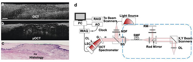 Figure 1. Micro-OCT images of fibrocalcific human cadaver coronary plaque, comparing corresponding OCT (a), micro-OCT (b), and histology (H&E of a calcium plate within the coronary artery wall) (c). A schematic of a benchtop micro-OCT system (d). Scale bar: 200 µm. Adapted with permission from Reference 3.