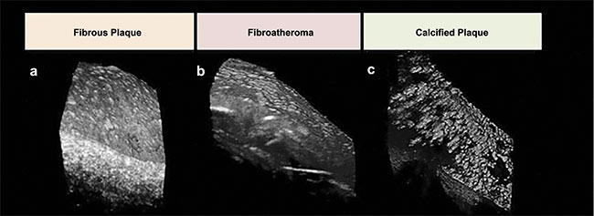 Figure 2. Representative micro-OCT images for varying plaque morphologies. Compared to the lesion with intimal hyperplasia (a), endothelial cells over fibroatheroma (b) and fibrocalcific plaques (c) are sparse. Adapted with permission from Reference 6.