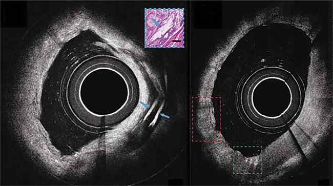 Micro-OCT views of coronary arteries with cholesterol deposits becoming visible. Adapted with permission from Reference 8.