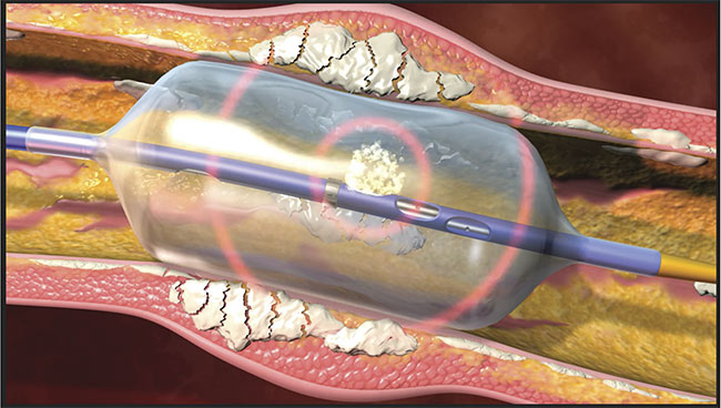 Figure 2. A fiber laser delivered through a catheter breaks up calcium deposits in arteries. Courtesy of Clayton Foundation for Research.