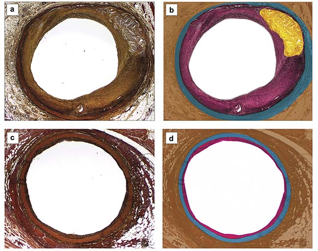 Figure 1. Movat’s Pentachrome stained slides of diseased (a) and healthy (c) coronary arteries. The corresponding representations show the layers: tunica externa (brown), tunica media (blue), tunica intima (pink), and lipid (yellow) (b, d). Note the increased thickness of the tunica intima and lipid core, only present in the diseased sample. Courtesy of Infraredx.