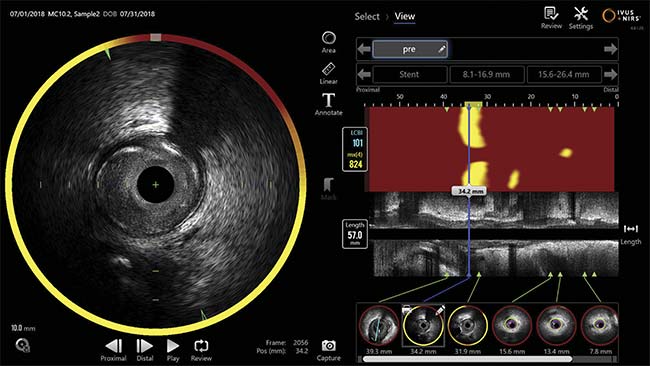 Figure 4. The Makoto console user interface shows the red-yellow chemogram (upper right) and the grayscale intravascular ultrasound (IVUS) longitudinal image (middle right). The chemogram shows lipid detected (yellow areas). The cross-sectional image contains the chemogram halo co-registered to the IVUS transverse image (left). Courtesy of Infraredx.
