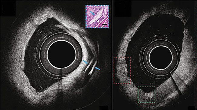 Catheter Use Propels Optical Coherence Tomography in Interventional Cardiology
