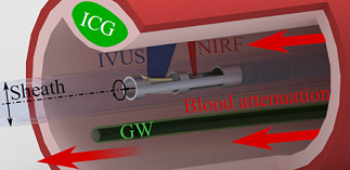 Coated Guidewire Boosts Intravascular Assessment Accuracy