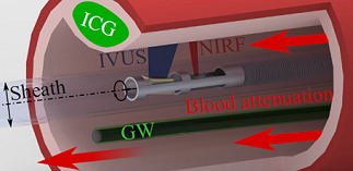 The variable fluorescence attenuation of blood has been a hindrance to near-infrared fluorescence (NIRF) measurements in cardiovascular imaging. Researchers at TUM devised an innovative correction method, in which the guidewire is coated with a fluorescent agent and used as a reference standard in each frame, leading to a much higher level of accuracy. Courtesy of Rauschendorfer, et al., doi: 10.1117/1.JBO.28.4.046001.