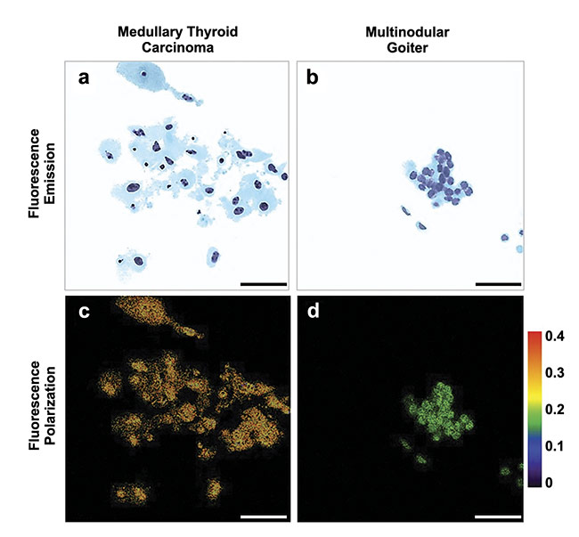 Figure 3. Multimodal optical images of cancerous and noncancerous thyroid cells. Scale bar: 50 µm. Adapted with permission from Reference 5/CC BY 4.0.