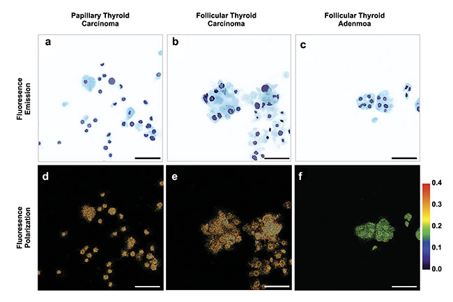 Figure 4. Multimodal optical images of cells with indeterminate cytology. Scale bar: 50 µm. Adapted with permission from Reference 5/CC BY 4.0.