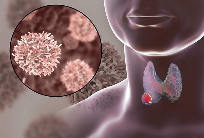 A 3D image of a thyroid gland with a tumor inside the body. Courtesy of iStock.com/Dr-Microbe.