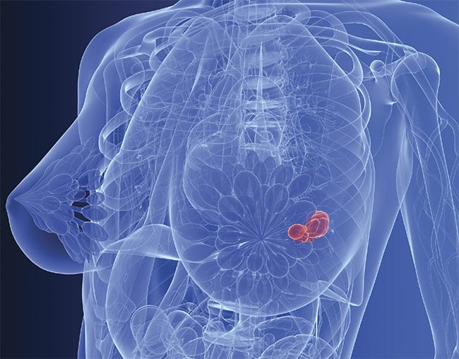 Breast cancer tumors have traditionally been the subject of extensive biopsy procedures, though new fiber optic technology could simplify the procedure. Courtesy of SciePro — stock.adobe.com.
