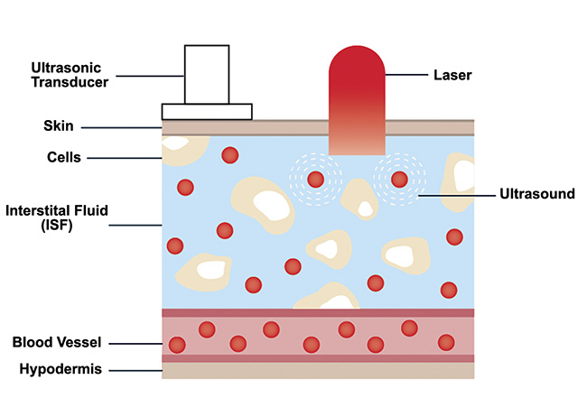 Figure 6. Sketch of human skin showing glucose distribution in the interstitial fluid layer. Courtesy of DRS Daylight Solutions.
