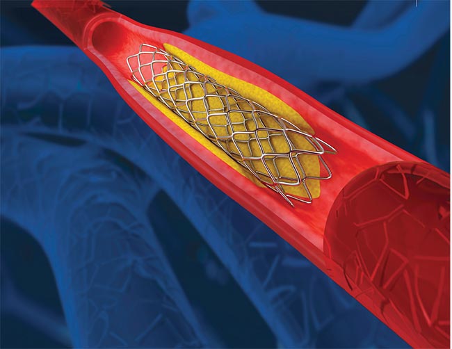 Micromachining cardiac stents is a familiar application for femtosecond lasers due to these sources' suitability for micromachining fine features. Courtesy of MKS Spectra-Physics.