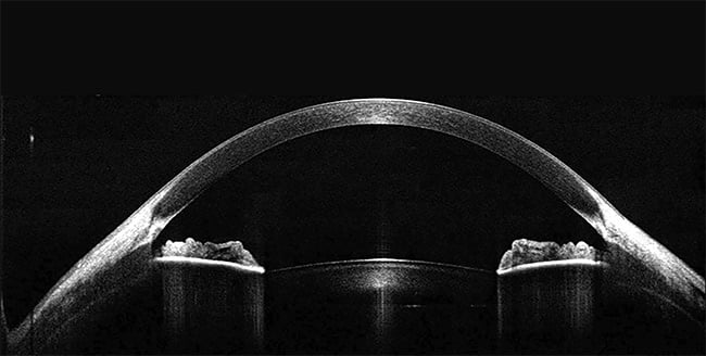 Figure 1. 1300-nm spectral-domain optical coherence tomography (SD-OCT) image depicting the structure of a cornea and anterior segment of the eye. Courtesy of Wasatch Photonics.
