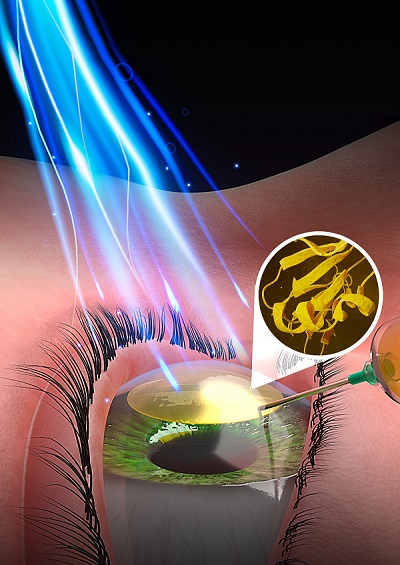 An injectable biomaterial activated by pulses of low-energy blue light has tremendous potential for on-the-spot repair to the domed outer layer of the eye, a team of University of Ottawa researchers and their collaborators have revealed. Courtesy of Faculty of Medicine, University of Ottawa.