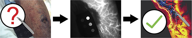 Figure 5. A conceptual rendering of how indocyanine green (ICG)-based dynamic contrast-enhanced fluorescence imaging may prove to be valuable for determining the spatial extent of necrotizing infection, thereby providing real-time guidance during surgical debridement of affected tissues. Courtesy of Dartmouth Health.