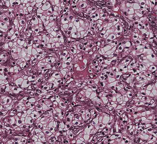 A virtually stained kidney tissue image showing compact nests and sheets of cells with clear cytoplasm and distinct membrane. Courtesy of the Ozcan Lab/UCLA.