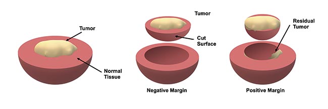 Figure 1. An illustration of how margins are defined during tumor resection. Typically, the resected tissue is evaluated by a pathologist to assess whether the tumor reaches the boundary, which implies that there may be some residual tumor in the patient — this is known as a positive margin. Courtesy of University of Arizona.