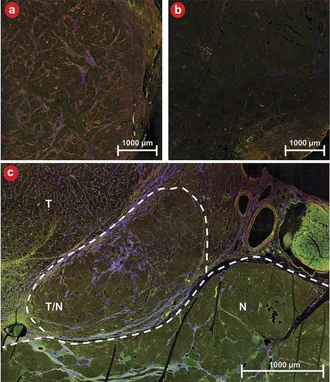 Figure 5. An example of three-channel multiphoton microscopy (MPM) images of diseased (a) and healthy (b) tissue as well as a boundary between diseased and healthy tissue (c). N: normal tissue; T: tumor tissue; T/N: region of mixed tumor and normal tissue. MPM shows strong contrast for distinguishing tissue types and margins. Courtesy of University of Arizona.