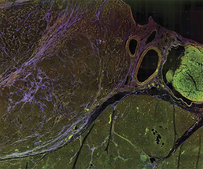 A multiphoton microscopy (MPM) image of tissue, showing striking contrast for identifying margins. Courtesy of University of Arizona.