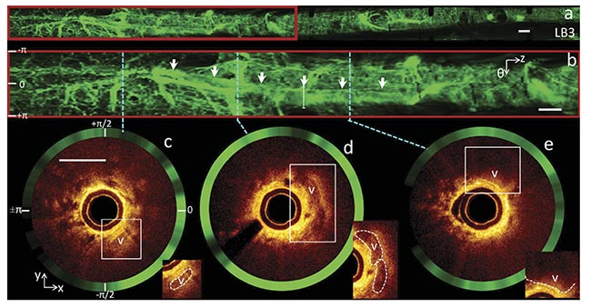 Figure 2. In vivo OCT and autofluorescence imaging (AFI) of human peripheral airways using a double-clad fiber (DCF) coupler. AFI of an airway (a), magnified AFI region (b), and OCT cross sections corresponding to the dashed lines (c-e). Adapted with permission from Reference 3/Optica Publishing Group.