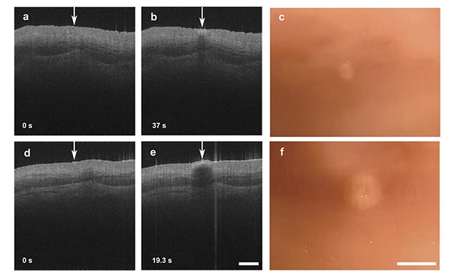 Figure 3. OCT imaging combined with laser coagulation using a double-clad fiber (DCF) coupler. OCT images before laser coagulation (a,d), OCT images after laser coagulation for pulse energies of 5.7 mJ and 8.6 mJ, respectively (b,e), and microscope photographs showing the coagulation marks (c,f). Adapted with permission from Reference 5/Optical Society of America.