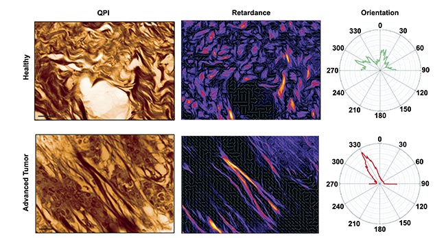 Figure 5. Quantitative phase imaging (QPI) (left) and retardance (right) of a mouse skin tissue for a healthy (top) and advanced tumor (bottom) sample. Only collagen fibers are revealed in the retardance image, whereas cells disappear. Radar representations of fiber orientation for both conditions are also shown. Courtesy of Phasics.