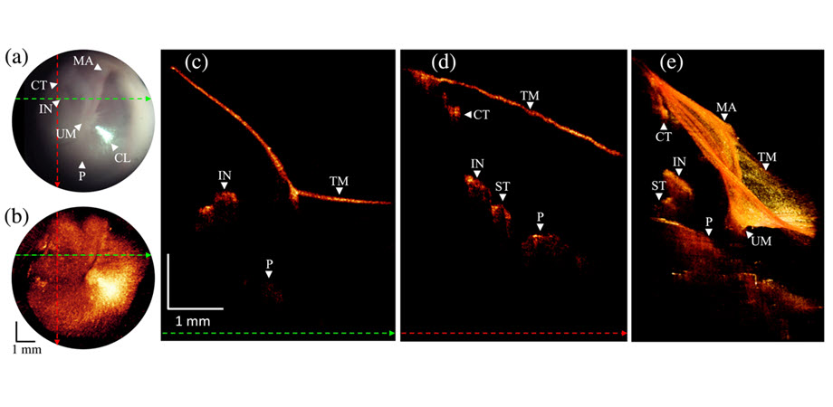 (a): A snapshot from the otoscopic video camera. Dashed colored lines indicate the positions where the linear scans are shown in panels (c) and (d). (c): Scan extracted along the green-colored dashed line from the OCT volumetric image. (d): B-scan extracted along the red-colored dashed line from the OCT volume. (e): 3D volume rendering of the ear. Abbreviations: MA, malleus; CT, chorda tympani; TM, tympanic membrane; IN, incus; UM, umbo; CL, cone of light; P, promontory.  Courtesy of W. Kim et al., doi 10.1117/1.JBO.29.8.086005.