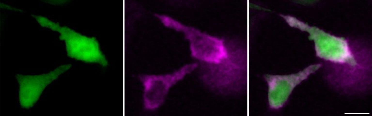Two human cells making RNA are made visible by the bioluminescent lantern in pink (middle image). (Left image): the same cells make a fluorescent protein that is distributed evenly throughout the two cells. (Right image): an overlay of the two images shows that the RNA is distributed unevenly and is concentrated at specific locations. The bar in the lower right corner of the third image is 20 µm. Courtesy of UC Irvine.