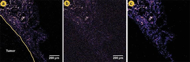 Figure 3. A comparison of second-harmonic generation (SHG) images at different laser power levels and denoising. A ground truth image of a tumor boundary in mammary gland tissue using higher laser power (a). A low-power image with significant noise (b). A denoised image using content-aware image restoration (CARE 2D), showing improved clarity and reduced noise (c). Adapted with permission from Reference 2.