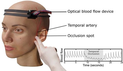 Setup of the laser speckle contrast optical spectroscopy system used to monitor scalp and brain blood flow during temporary blockage of a major scalp artery near the temple. Courtesy of UCLA.