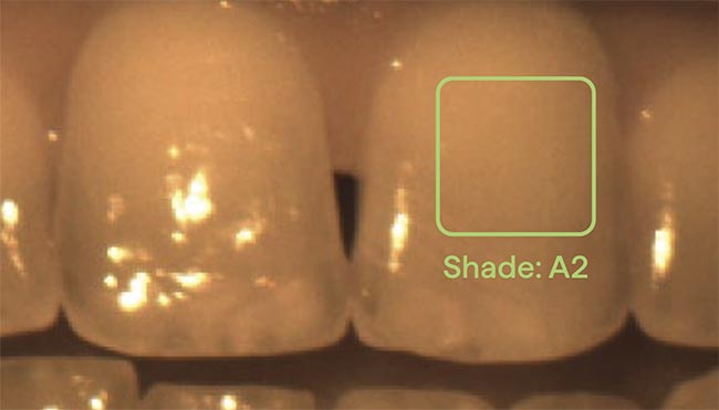 Figure 4. A hyperspectral image of a human tooth, annotated with the best VITA Classical shade match calculated for the rectangular region (green). Courtesy of Living Optics.