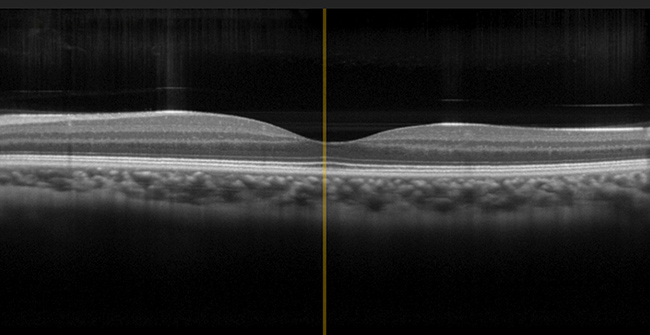 Photonic Integrated Circuits Enable High-Speed OCT Imaging of the Eye