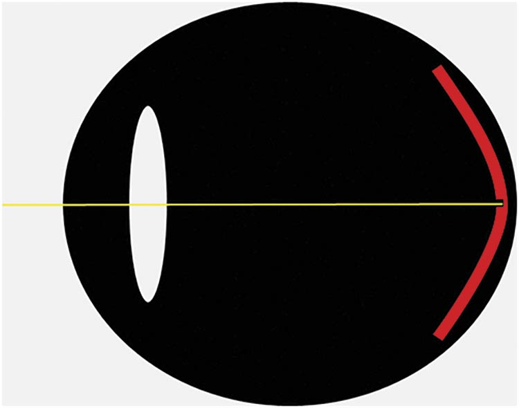 Figure 1. The fovea is a small ‘back-thinned’ region of the retina at the center of the eye’s optical axis (top). A replot of published human data showing the ~50× cone density difference between the fovea and most of the retina (bottom). Courtesy of ORCA Med.