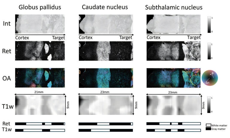 PS-OCT provides higher resolution and contrast images than MRI, as demonstrated in three common DBS targets: the subthalamic nucleus (right), the caudate nucleus (center), and the globus pallidus (left). Courtesy of S. Masoumi et al., doi 10.1117/1.NPh.12.3.035001.